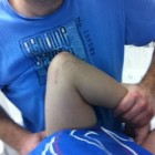 שיקום מרפק לאחר שבר מרוסק וקיבוע עם פלטה וברגים – מאיר לנקרי – אבחנה, טיפול והחלמה – תאור מקרה.